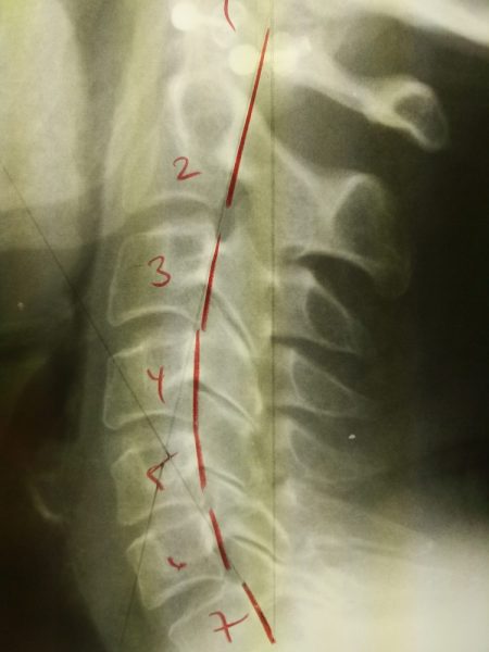 neck x-ray newmarket chiropractor