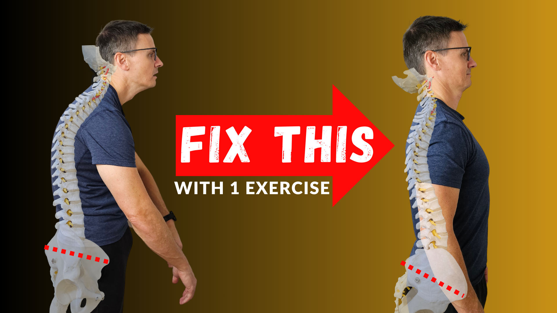 What Can You Do To Help Degenerative Disc Disease (DDD)? - Chiropractic on  Eagle, Dr. Jon Saunders