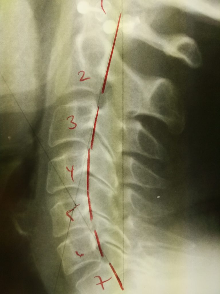 neck x-ray newmarket chiropractor