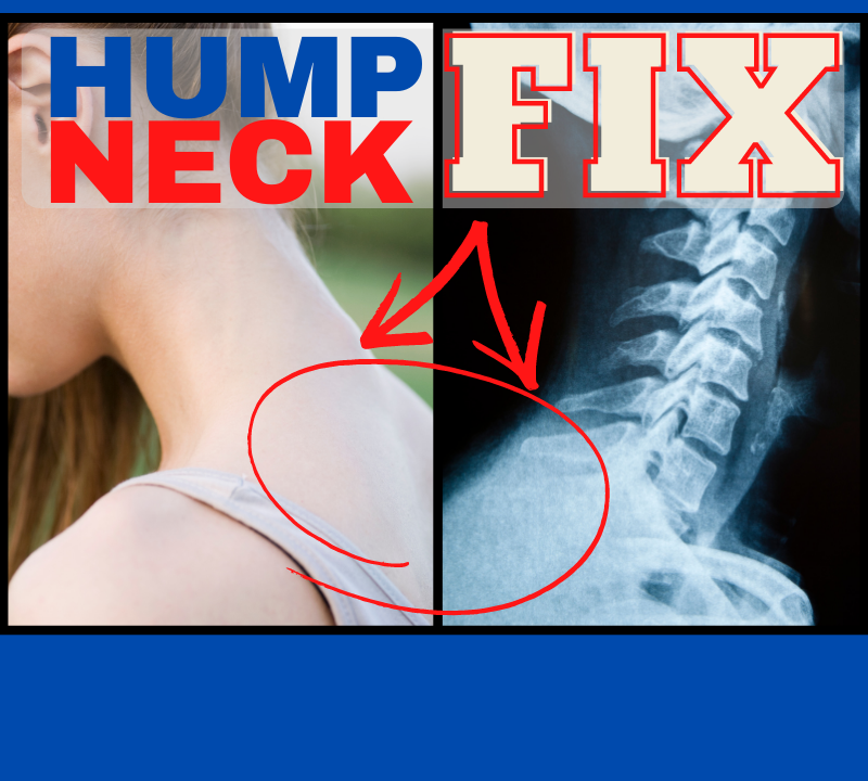 How To Get Rid of Neck Hump (Kyphosis) the Easy Way